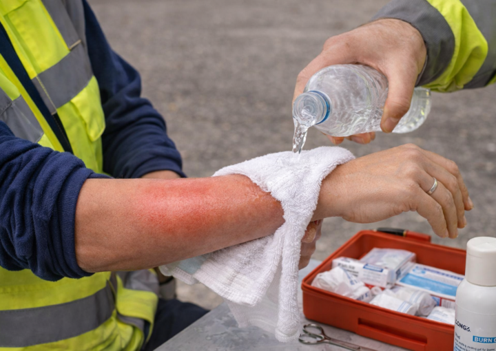 Types of Burns Degrees: First, Second, Third