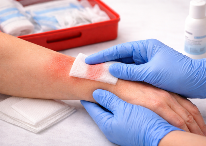 How to Treat Minor Burns Safely at Work