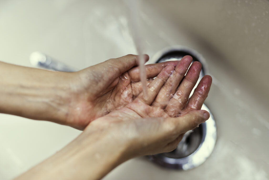 washing a burned hand using cool water